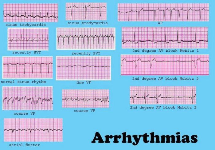 Lesson 11.2 identifying arrhythmia patterns